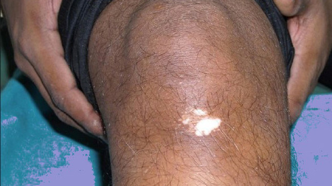 Gejala Awal Terkena Penyakit Vitiligo